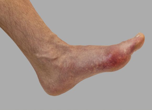 Křečové žíly a Bércové vředy