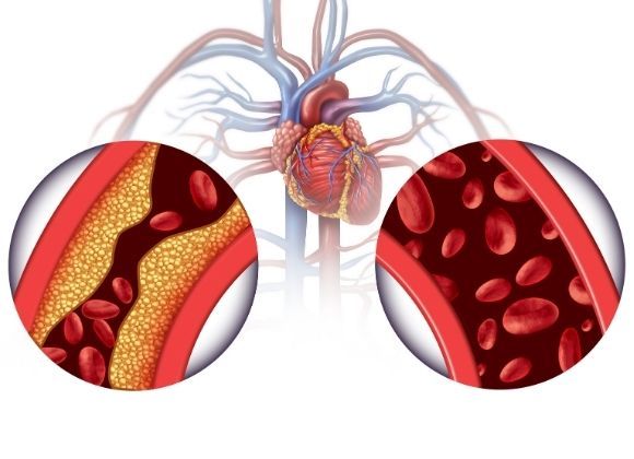 Cholesterol v žilách