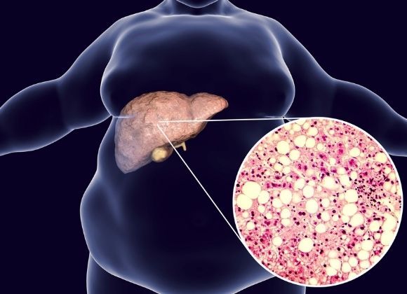 Ztukovatělá játra